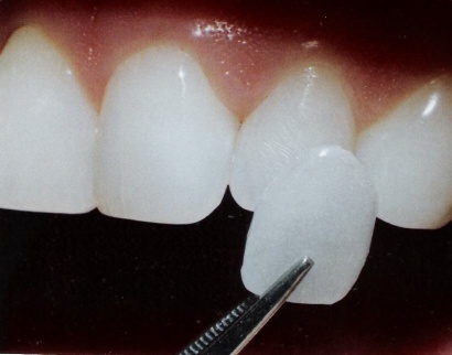 протезирование зубов в Астане